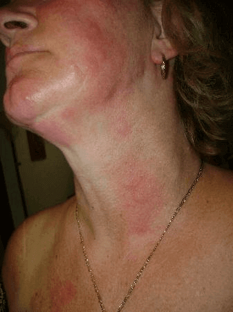 hard water rash pictures